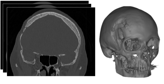 Ct-scan Segmentation & 3d Reconstruction - Ct Scan Transparent (532x360), Png Download