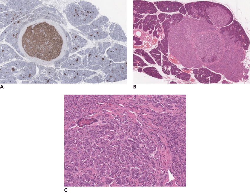 37 Beta Cell Tumors, Ferret - Abcès En Bouton De Chemise (850x657), Png Download