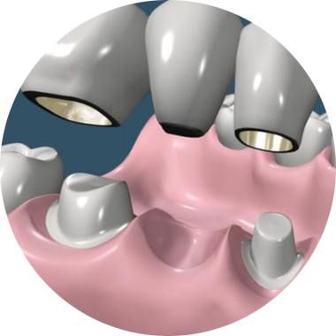 Coronas Y Puentes - Prostodoncia Odontologia (380x380), Png Download