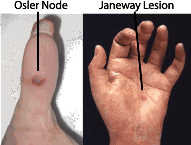 Janeway And Osler - Janeway Lesions And Osler's Nodes (620x479), Png Download