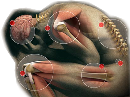 Its Effectiveness To Reduce Acupuncture For Pain - Somatization Disorder (431x317), Png Download