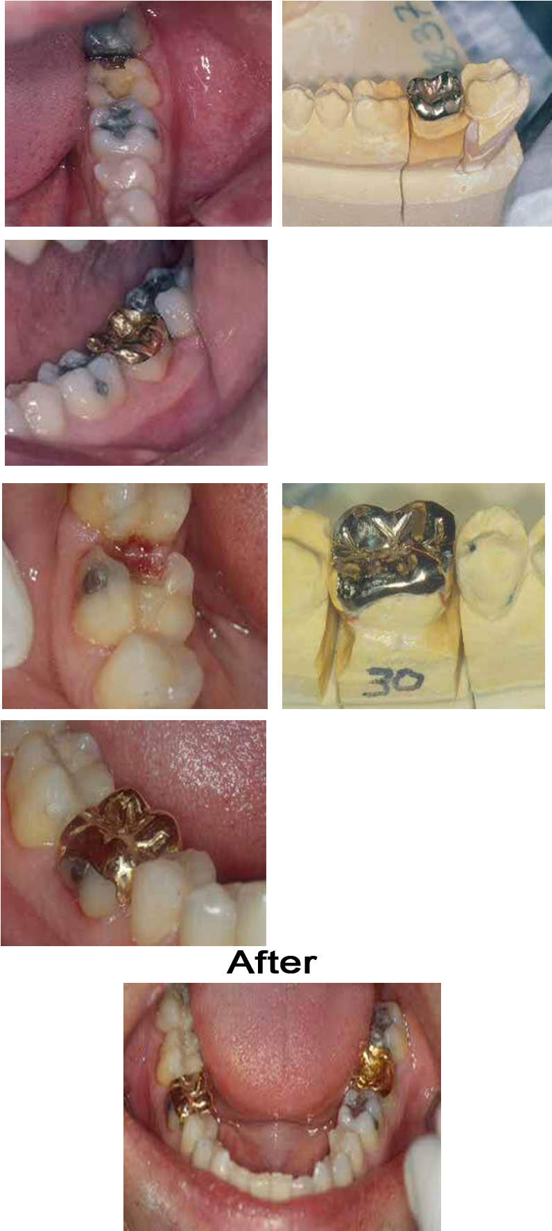 In This Case Two Gold Onlays Were Cast For The - Washington, D.c. (890x1775), Png Download