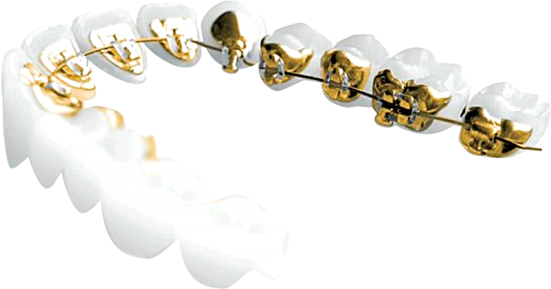 100% Customized And 100% Hidden, Incognito™ Braces - Incognito Braces Png (800x418), Png Download