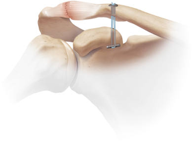 Acromioclavicular Joint Separation 1 Large - Dog Bone Arthrex (400x370), Png Download