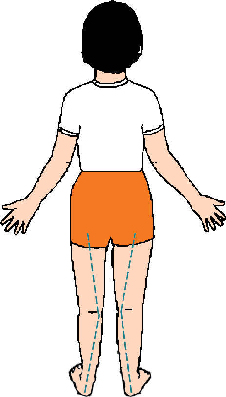 "over Pronation" Means That, As Your Child Walks They - Illustration (476x831), Png Download