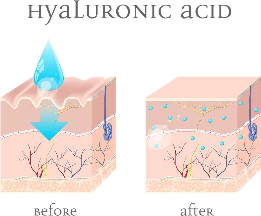 Illustration Of Before And After-effects Of Hyaluronic - Injectable Filler (1050x1050), Png Download