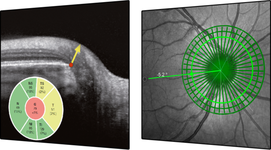 Glaucoma Module Premium Edition - Glaucoma (540x300), Png Download