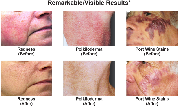 *these Results Were Obtained After Multiple Treatments - Vbeam Laser (675x377), Png Download