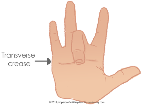 Limitation Of Motion Of The Fingers - Sign (493x365), Png Download