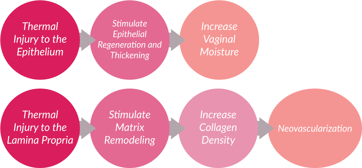 Vaginal Dryness Cure With Laser In Montreal - Montreal (1227x600), Png Download