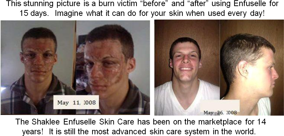 Shaklee Enfuselle - “ - Burn Skin Care Before And After (1179x585), Png Download