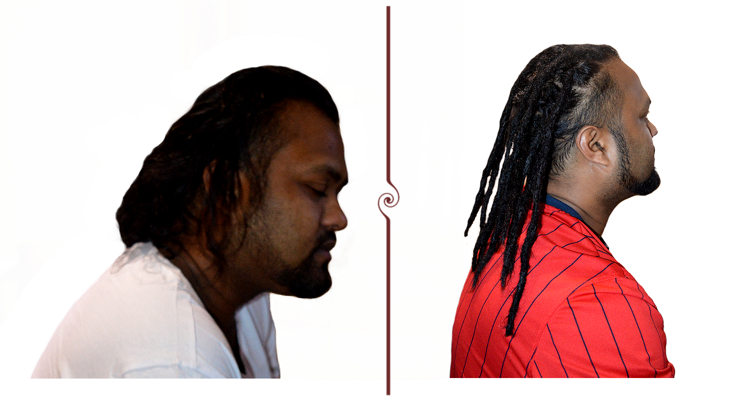 Neil Loc Extensions Before And After - Dreadlocks (1554x800), Png Download
