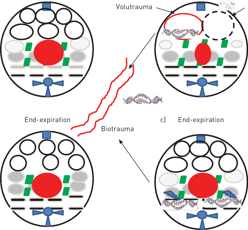 A) The Distribution Of Normally Aerated (white Circles), - Prone Ventilation (845x784), Png Download