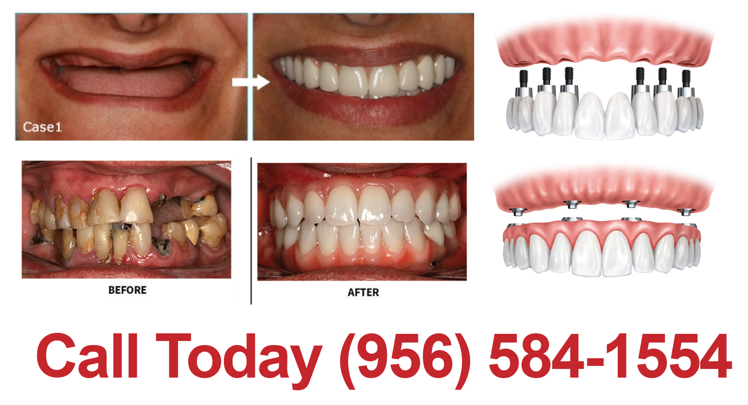 New Smile In 1 Day - New Smile Dental (1469x808), Png Download