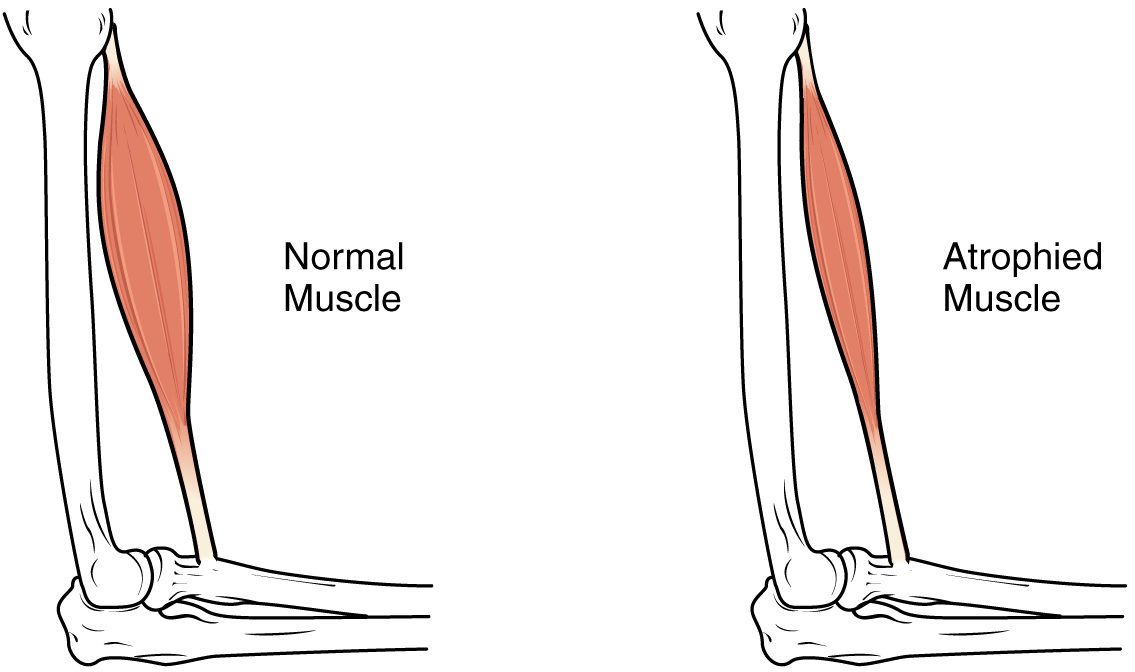 This Image Shows Muscle Atrophy - Muscle Atrophy (1135x672), Png Download