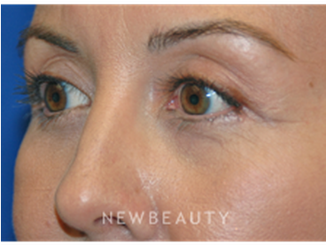 Dr Martin Otoole Blepharoplasty B - Blepharoplasty (367x441), Png Download