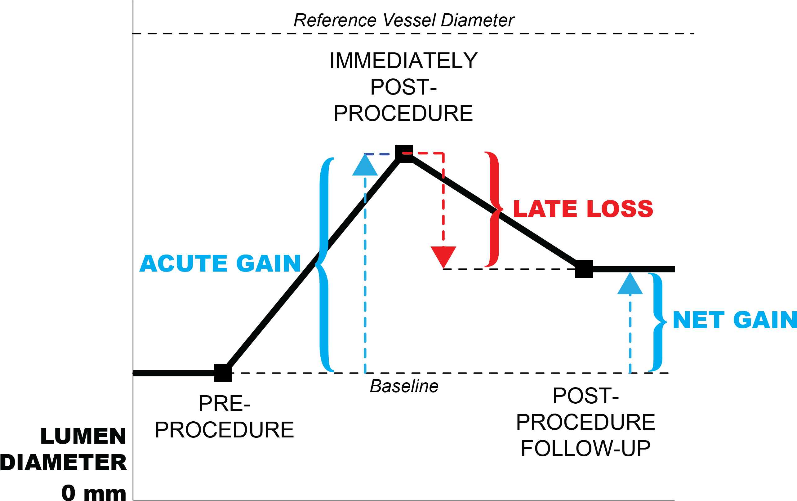 Late Loss Restenosis - June 13 (2579x1635), Png Download