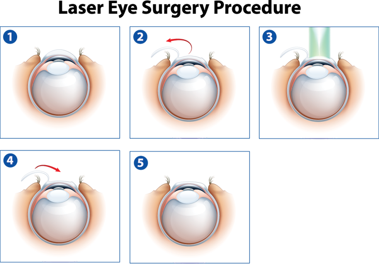 Laser Eye Surgery Procedure (750x523), Png Download