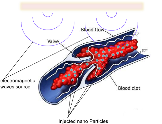 Removing Blood Clots Using Nano-particles - Blood Clot (575x443), Png Download