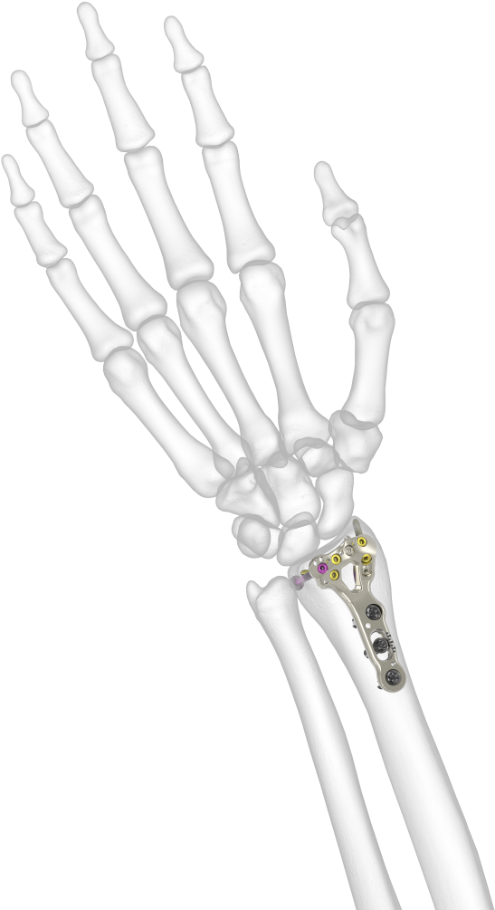 Acu Loc 2 - Skeleton Hi Res Arm (576x1024), Png Download