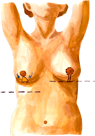 Vertical Incision Breast Reduction Scheme - Sv Plastinės Chirurgijos Centras (480x639), Png Download