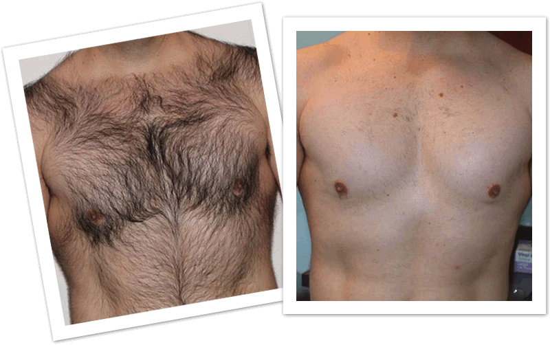 Download Chest Hair Png Picture Transparent Before And After Body Wax Full Size Png Image Pngkit