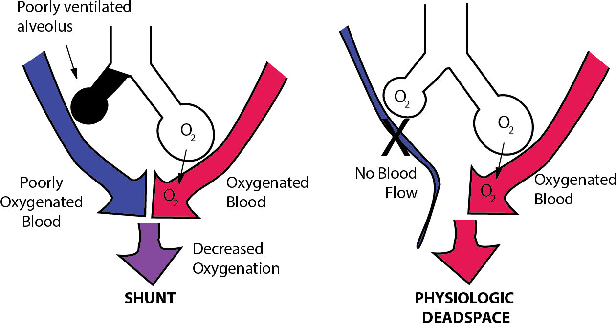 Ventilation Perfusion Mismatch - Pulmonary Shunt (1263x674), Png Download
