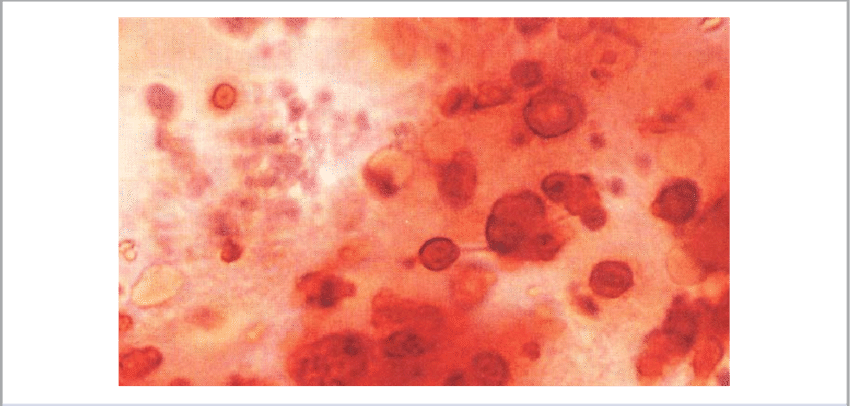 A Synovial Fluid Wet Smear Stained With Alizarin Red - Synovial Fluid Alizarin Red (850x406), Png Download