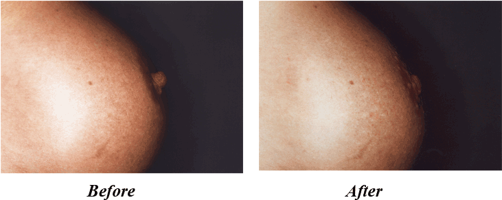 Nipple Reduction - Nipple Injections Before And After (730x300), Png Download