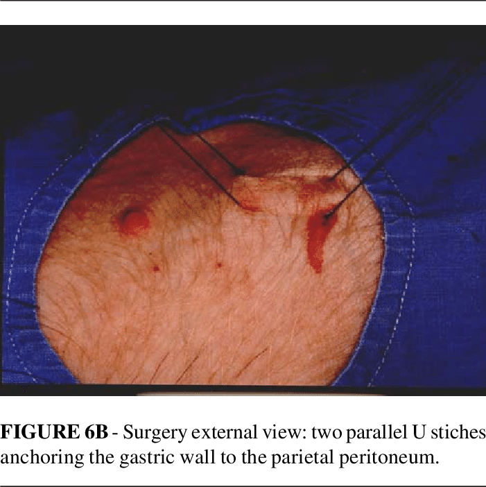 A-schematic Gastric View - Oftalmopatia Tiroidea (701x702), Png Download