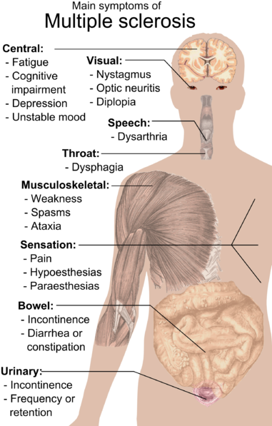 “main Symptoms Of Multiple Sclerosis - Multiple Sclerosis Symptoms (394x600), Png Download