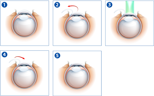 The Doctors At New Orleans Eye Specialists Have Performed - Laser Eye Surgery Procedure (526x328), Png Download