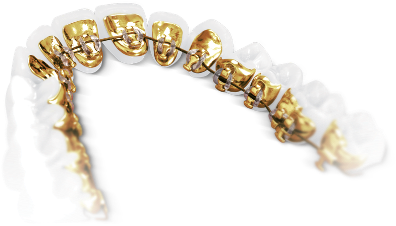 Lingual Braces Sydney - Incognito Braces (865x503), Png Download