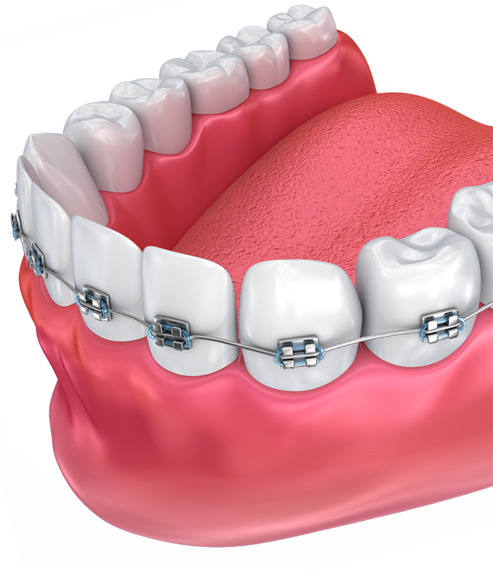 Png Transparent Braces (700x808), Png Download