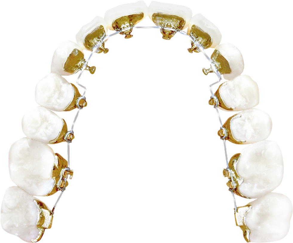 Lingual Braces - Incognito Lingual Braces Png (1000x835), Png Download