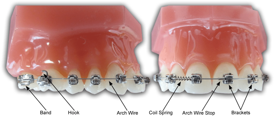 Images Braces Diagram - Philadelphia (1000x408), Png Download