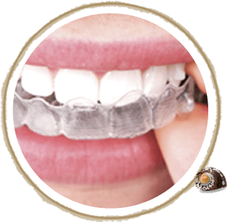 Types Of Braces - Invisible Braces (367x327), Png Download