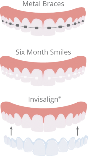 Teeth Straightening Illustration - Orthodontics (300x532), Png Download