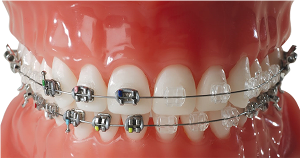 Brackets-blancoss - Brackets Invisibles (600x600), Png Download