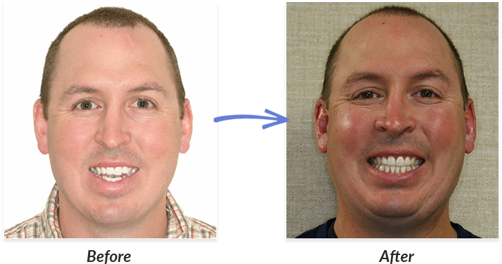 Before And After Braces Photo - Before Braces (727x403), Png Download
