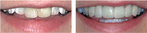 Before And After Teeth Whiting Treatment Case - Veneer (600x230), Png Download