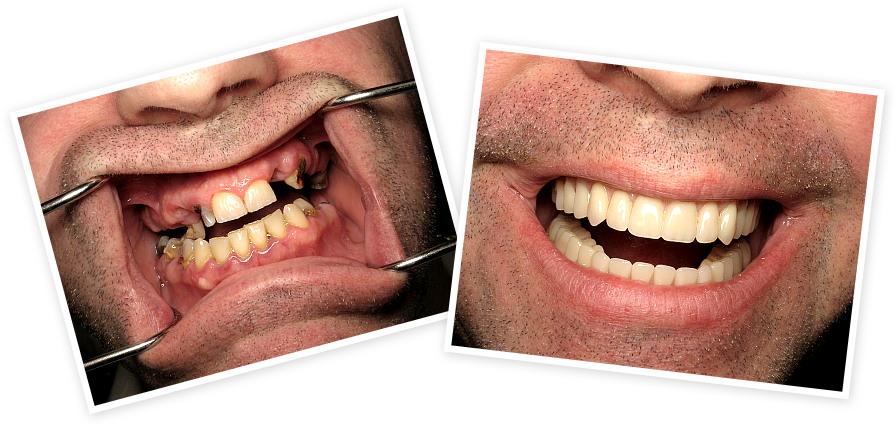 Find Out How To Replace Missing Teeth Without A Denture, - Tongue (896x426), Png Download