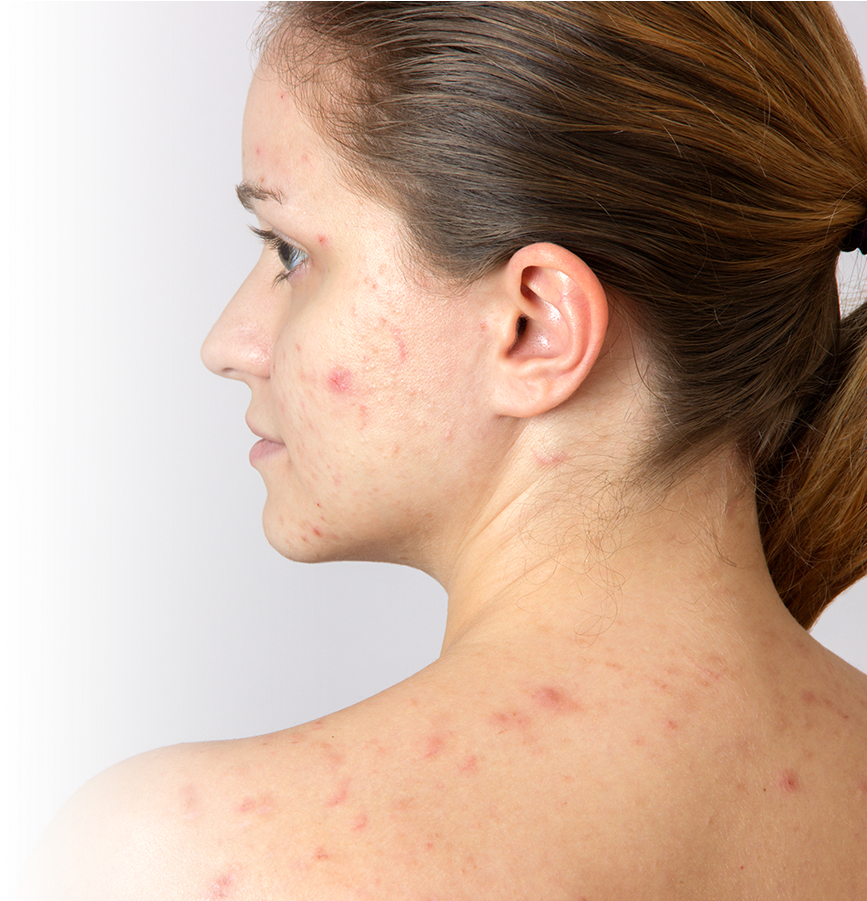 6 Solutions To Get Rid Of Adult Acne - Pregnancy Acne (900x900), Png Download