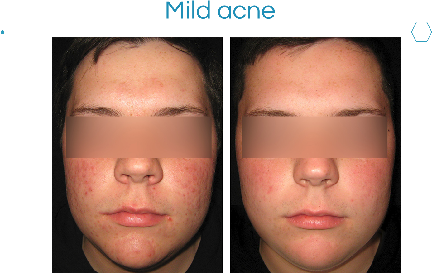 Acne Can Be Very Frustrating To The Patient And Have - Myers Dermatology (1385x951), Png Download