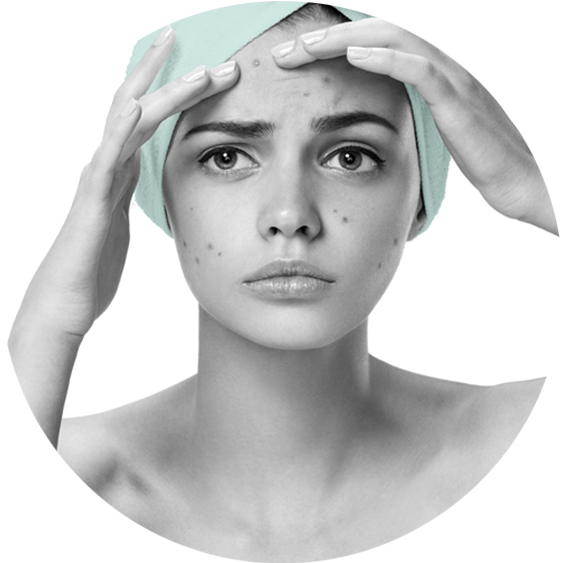 Noticia Anterior Acne Y Cicatrices Corporal Siguiente - Acne En Adolescentes (625x625), Png Download