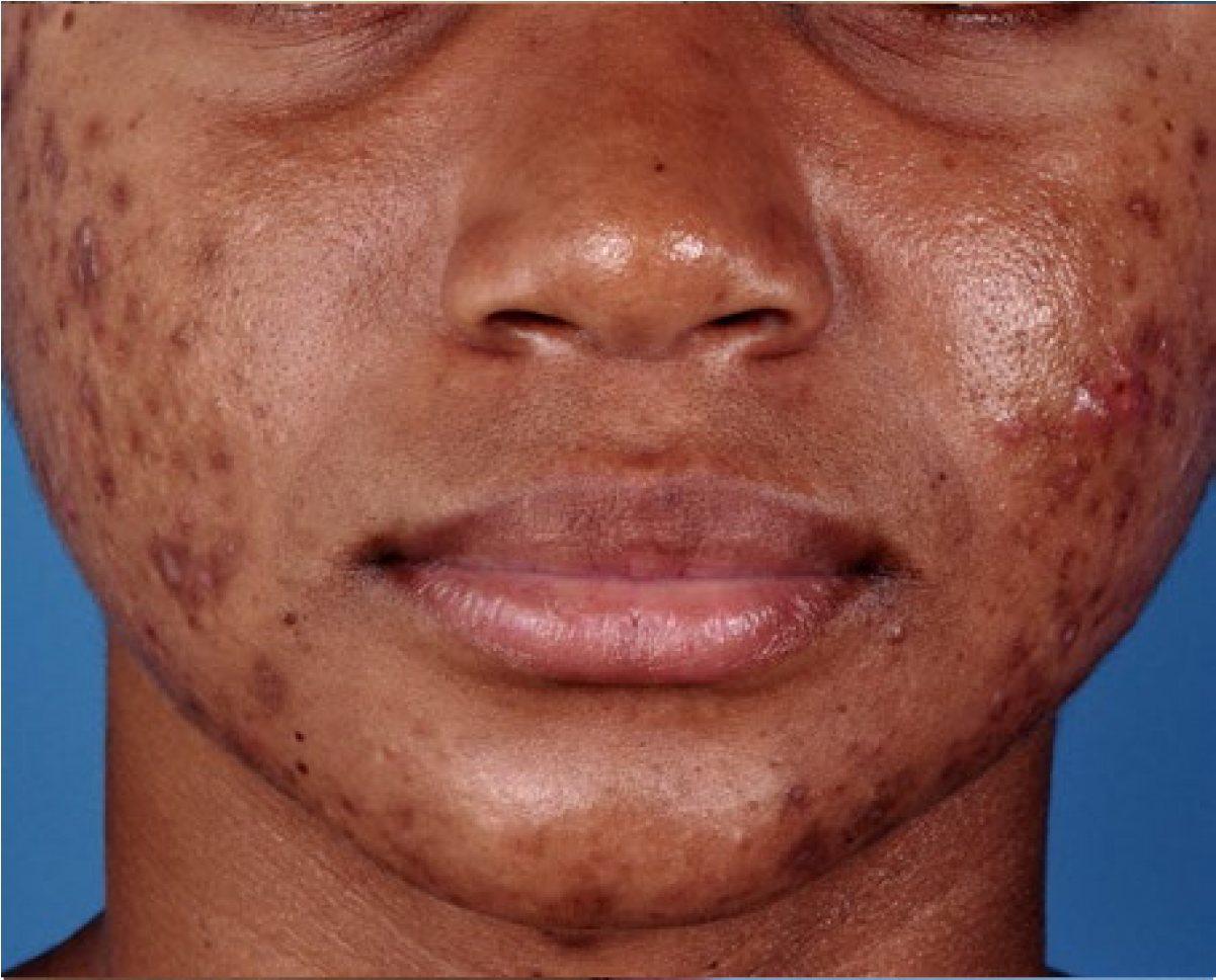 Zo® Oil Control Pads Acne Treatment Before - Zo Medical Before And After (1200x1200), Png Download