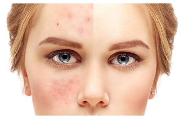 Acne Treatment - Gerötete Gesichtshaut (586x379), Png Download