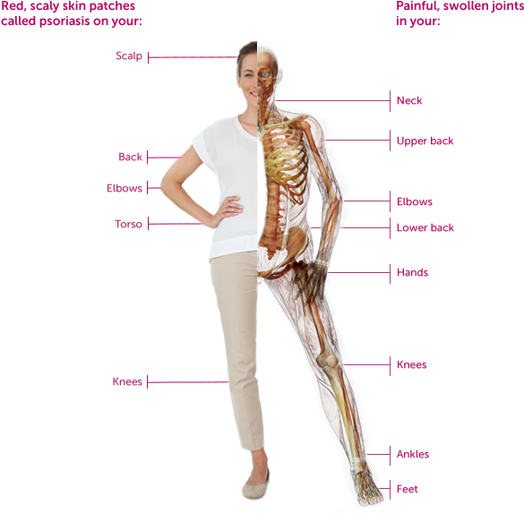 Some People Have Psoriasis Symptoms For 10 Years Before - Psoriatic Arthritis Pain (600x580), Png Download