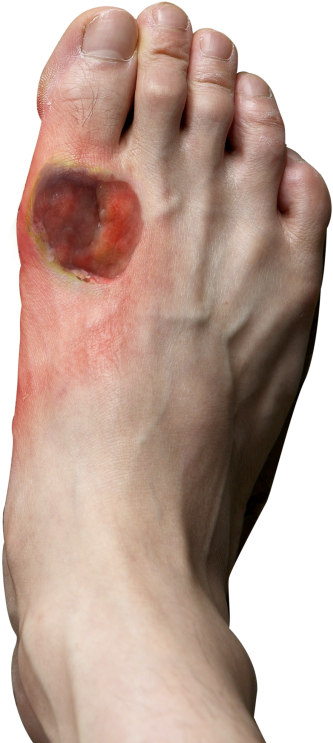 Signs And Symptoms Of Diabetic Foot - Diabetes Foot (532x814), Png Download