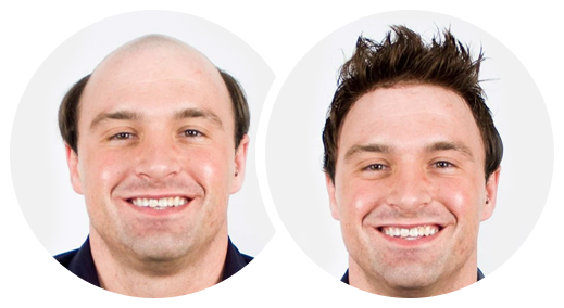 toupee before and after